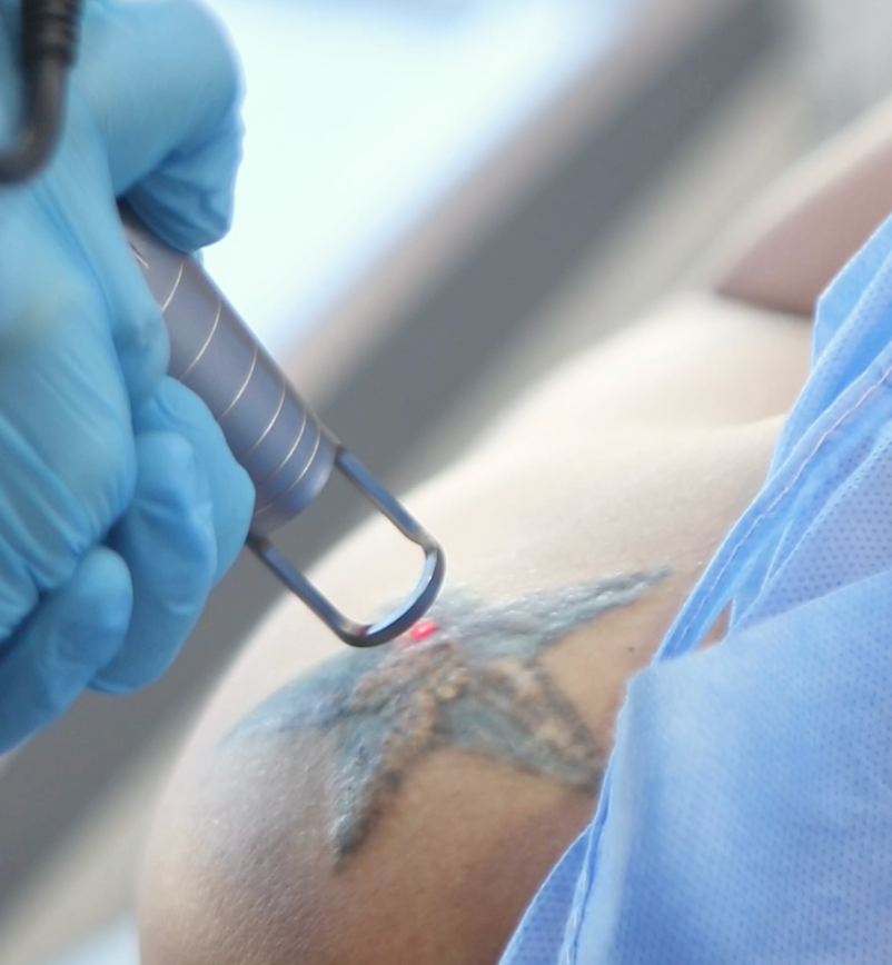 Borrado de tatuajes en Medical Skin Center
