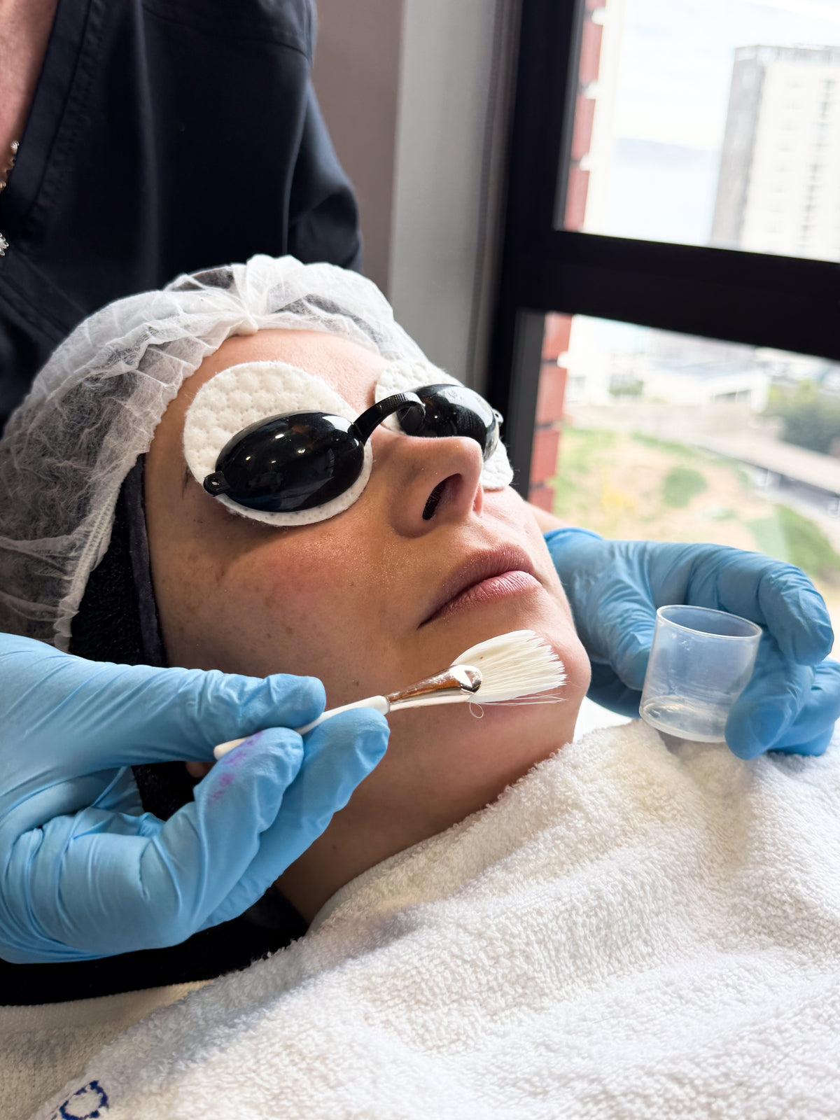 Peeling Químico en Medical Skin Center