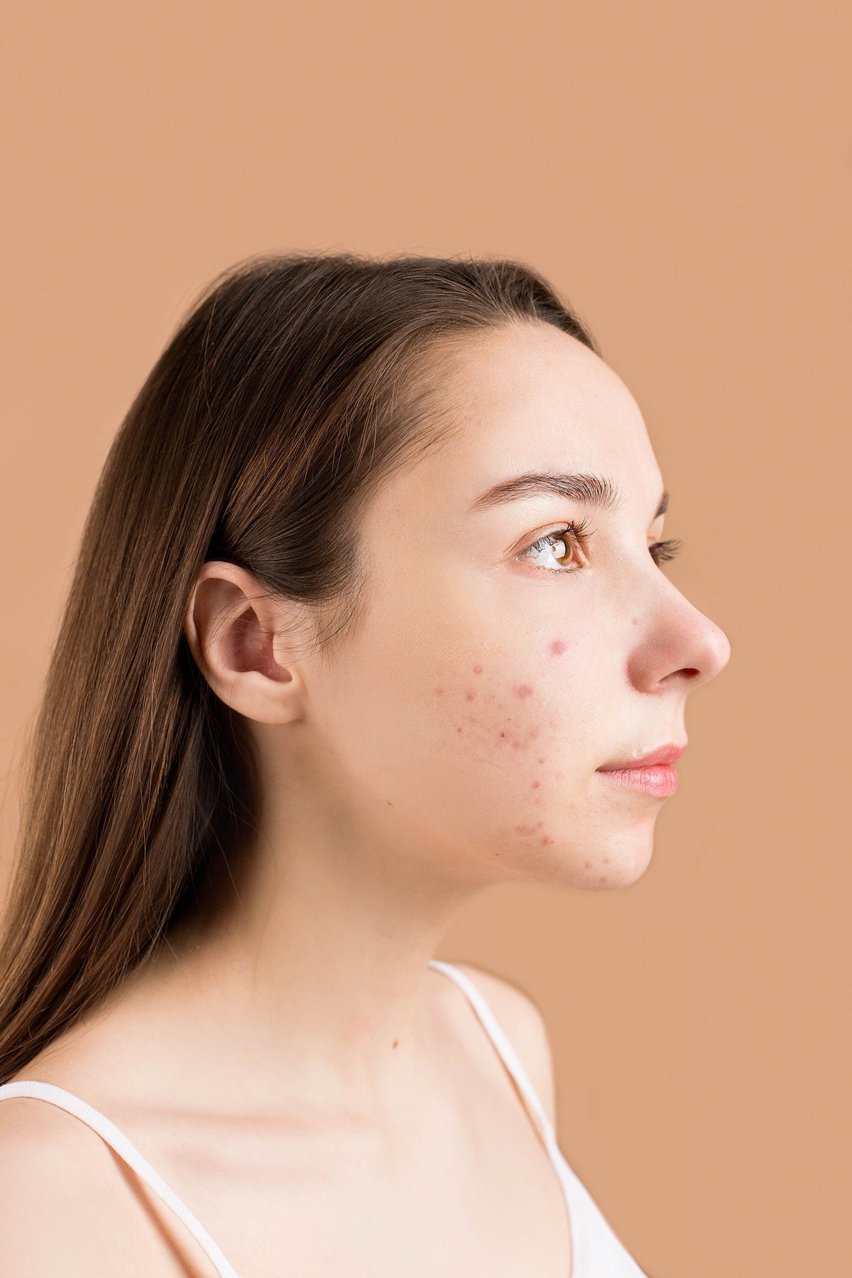 Evaluación dermatológica de acné y cicatrices